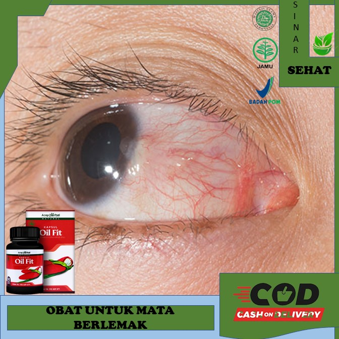 obat mata berlemak  Obat Mata Berlemak OBAT MATA BERLEMAK PTERIGIUM, Penghilang Lamad Lemak Pada Sud