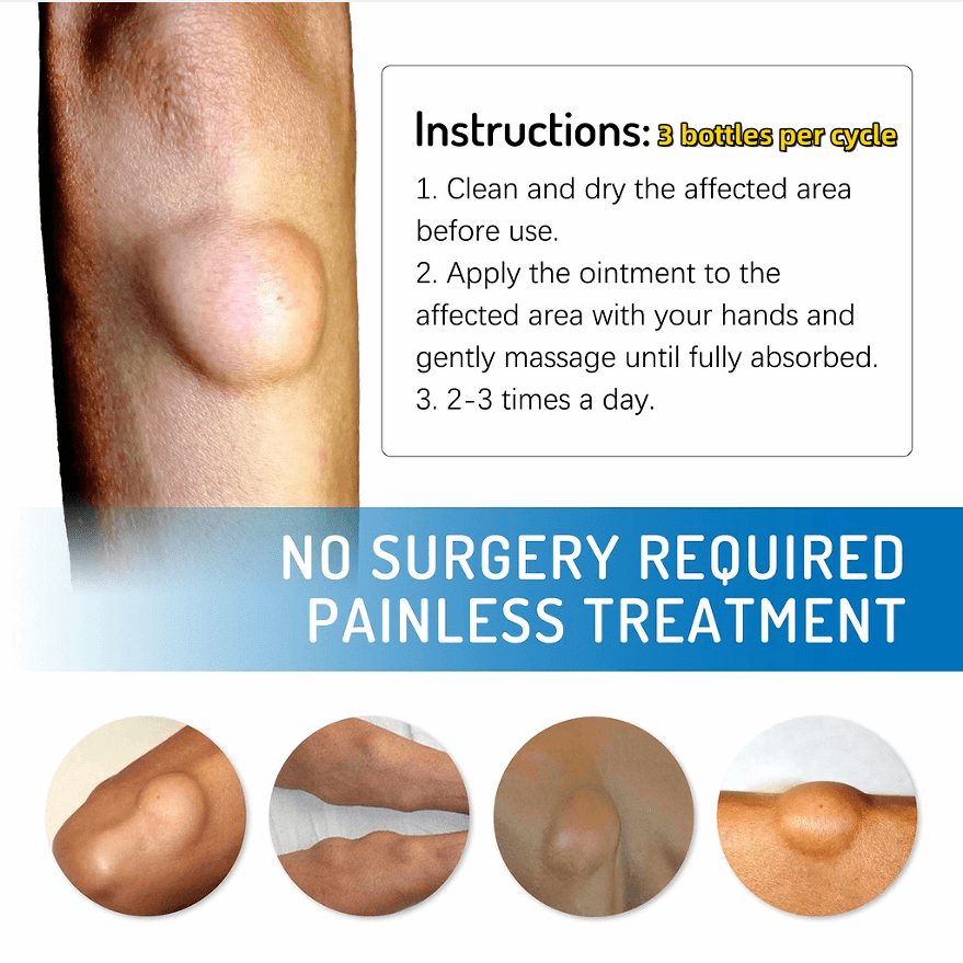 Obat Benjolan Lipoma Krim lipoma OBAT OLES PENGHILANG BENJOLAN LIPOMA 30g