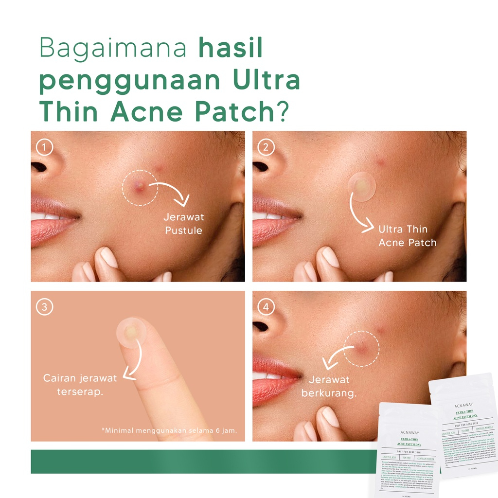 ACNAWAY Ultra Thin Acne Patch 24 pcs Acne Treatment Sticker Jerawat Super Tipis Penghilang Jerawat with Salicylic Acid Tea Tree