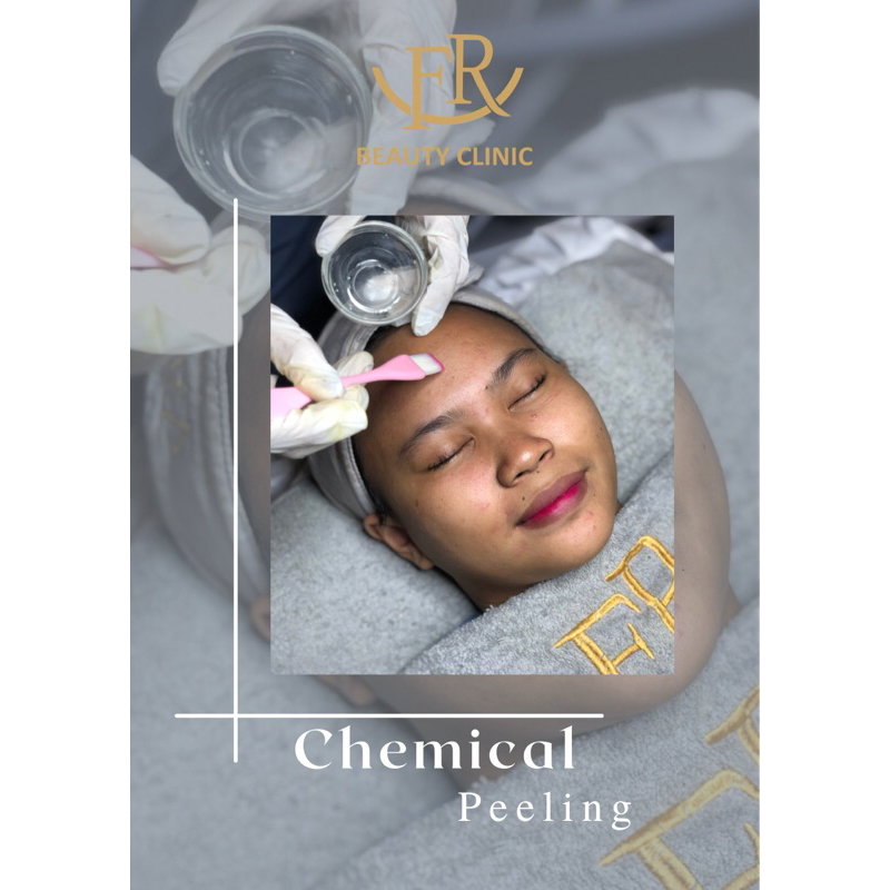 Chemical Peeling Wajah