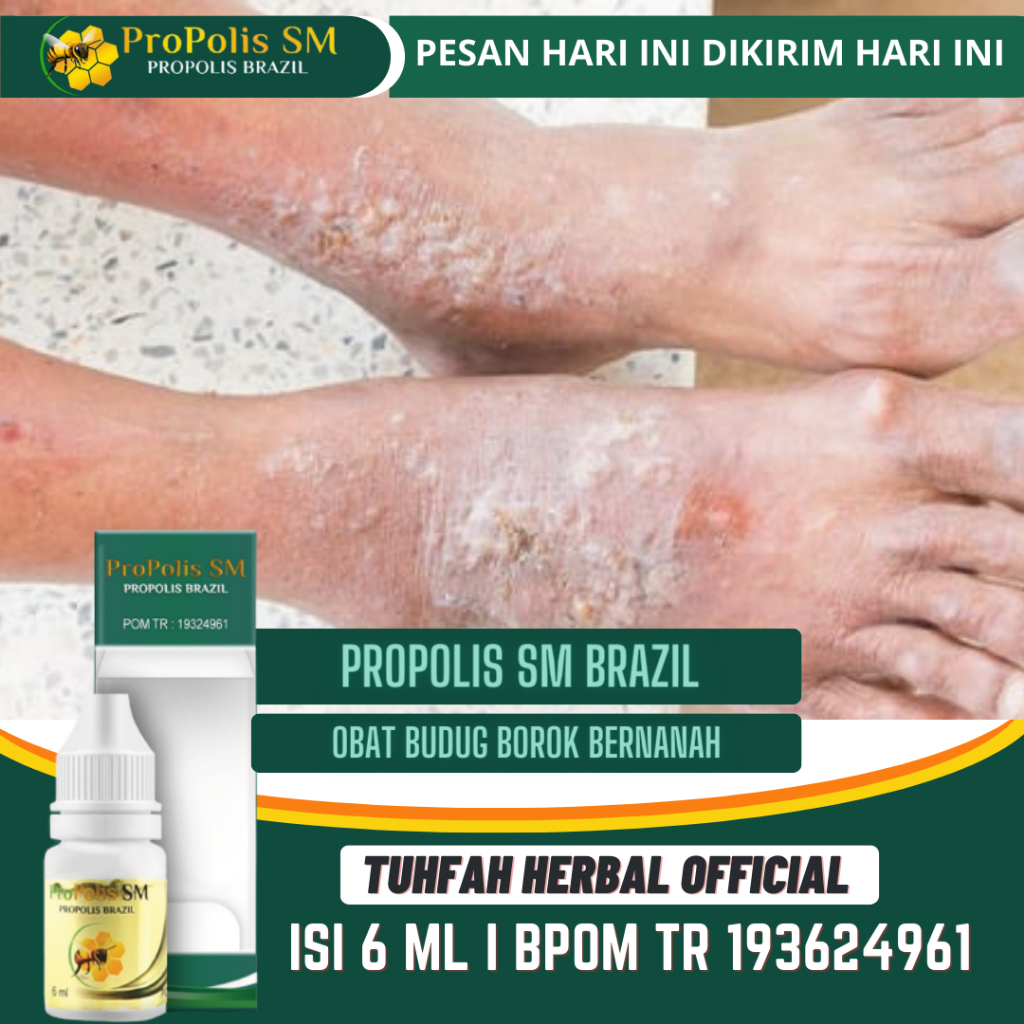 Obat Budug dan Gatal, Budug Santri, Budug Bernanah, Budug Di Tangan dan Kaki, Budug Borok Bernanah, 