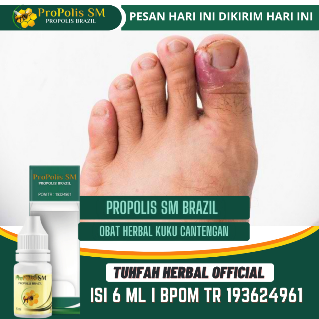 Obat Cantengan Kaki dan Tangan, Obat Catengan Jempol Kaki, Jempol Kaki Bengkak dan Bernanah, Canteng