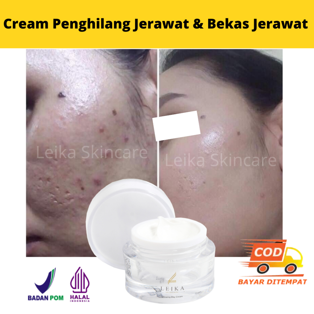 [CEPAT] Penghilang Jerawat Dan Bekas Jerawat Bpom Ampuh Cream Penghilang Jerawat Dan Memutihkan Peng