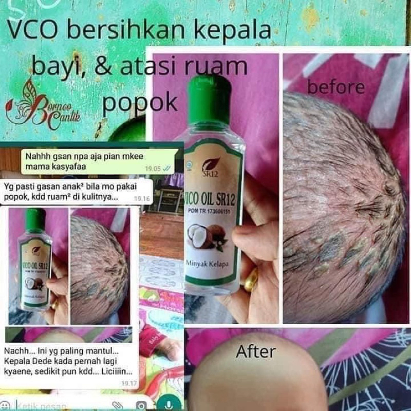 MINYAK KELAPA ASLI , VCO OIL , VCO SR12 , MENGATASI CRADLE CRAP PADA BAYI , OBAT ALERGI BAYI , MINYAK URUT BAYI