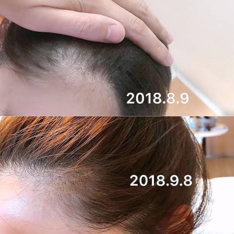 SERUM PENUMBUH RAMBUT DAN ANTI RONTOK JEPANG MENUMBUHKAN JUGA MELEBATKAN EFEKTIF DAN PASTI BERHASIL SERUM ALOPECIA SERUM SEBORRHEA