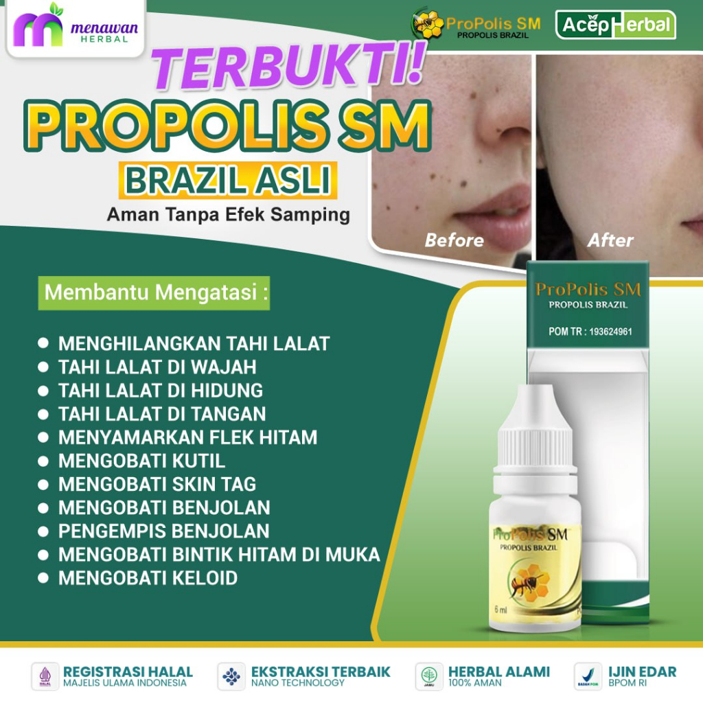 Propolis SM - Penghilang tahi lalat, Obat penghilang tahi lalat di wajah, Obat tahi lalat di wajah, 
