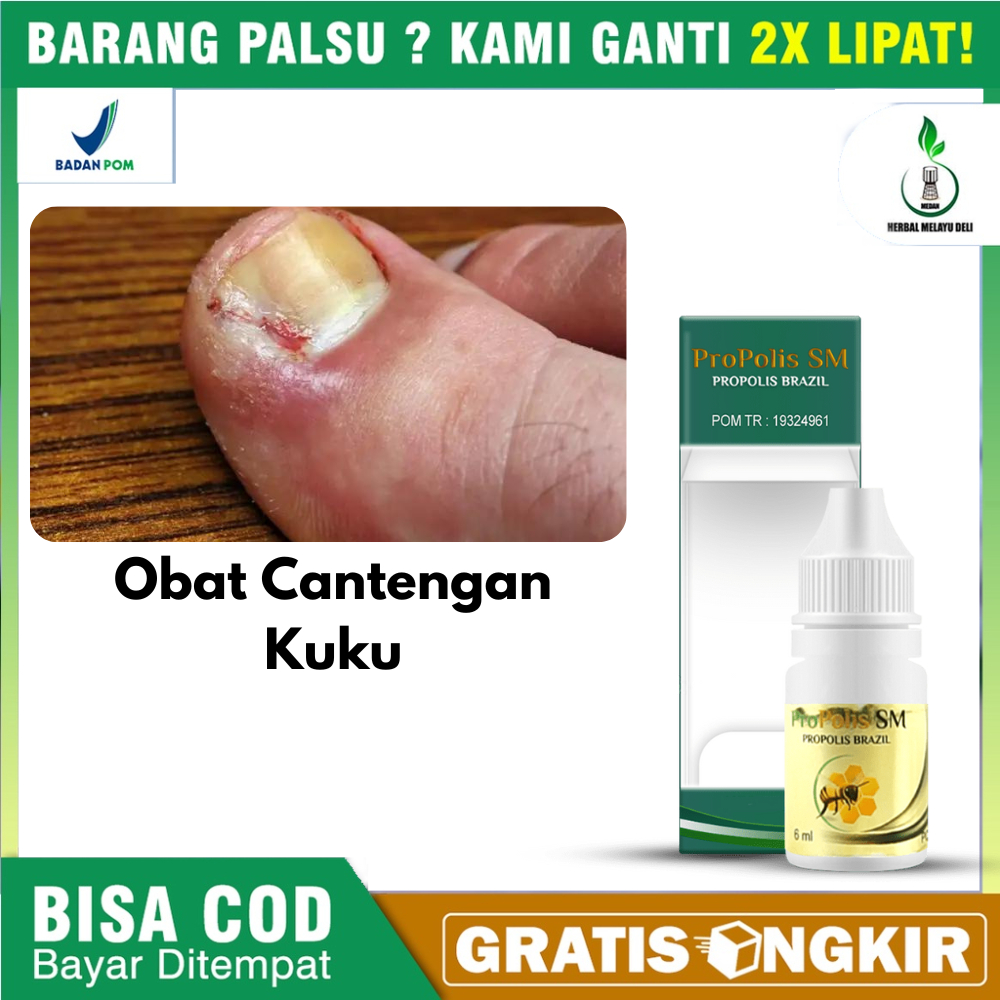 Obat Untuk Cantengan Di Jempol Kaki Obat Cantengan Kuku Propolis Sm Original 100% Sudah BPOM