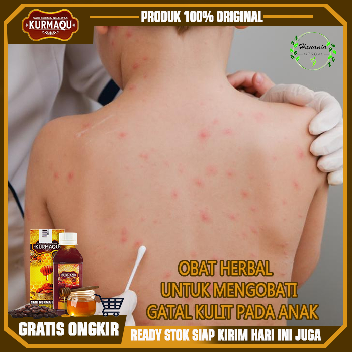 Obat Pengurang Gatal Kulit Anak, Rekomendasi Obat Gatal untuk Anak yang Aman, Obat Gatal Anak Paling