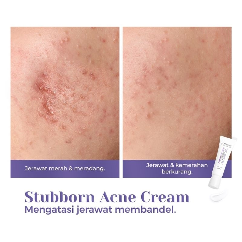 ACNAWAY Stubborn Acne Cream Krim Jerawat Acne Spot Treatment