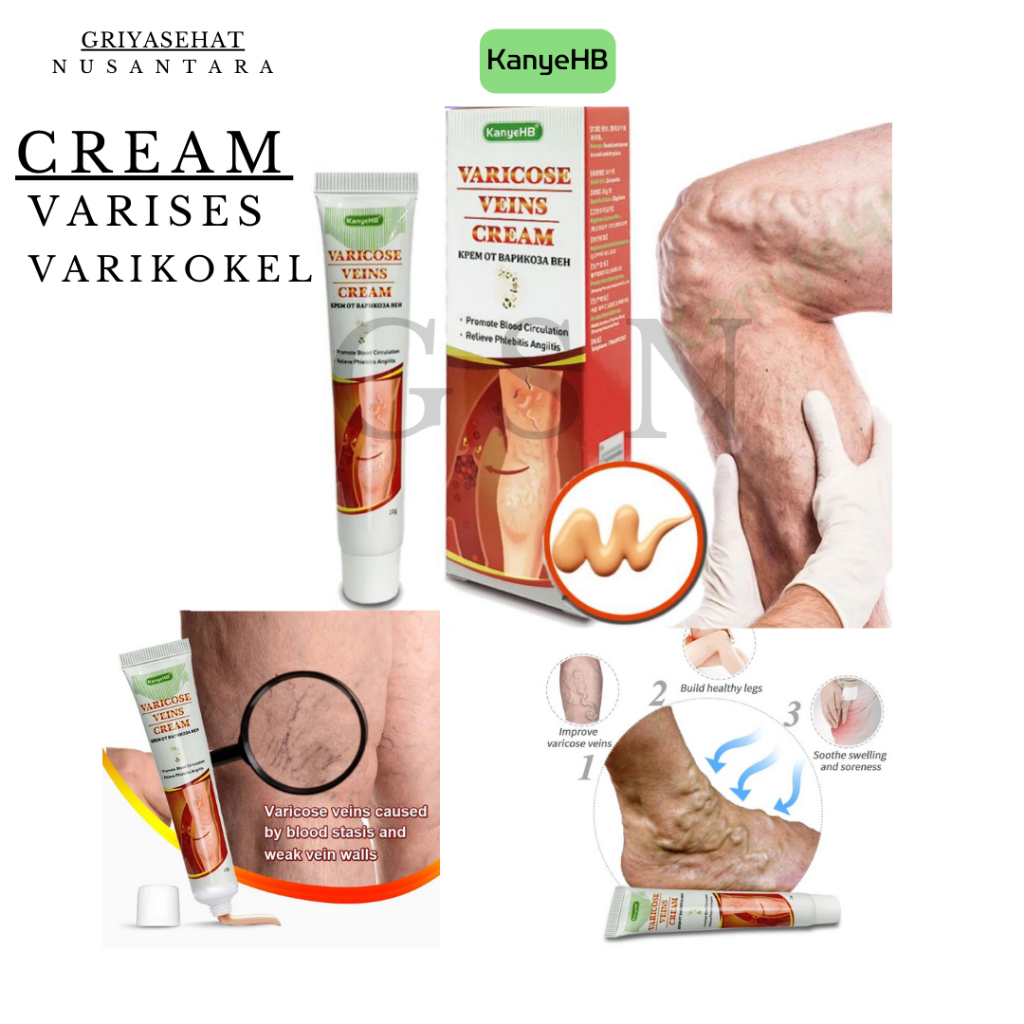 VARISES VARIKOKEL/CREAM VARISES/OBAT SALEP CREAM VARISES SANGAT AMPUH