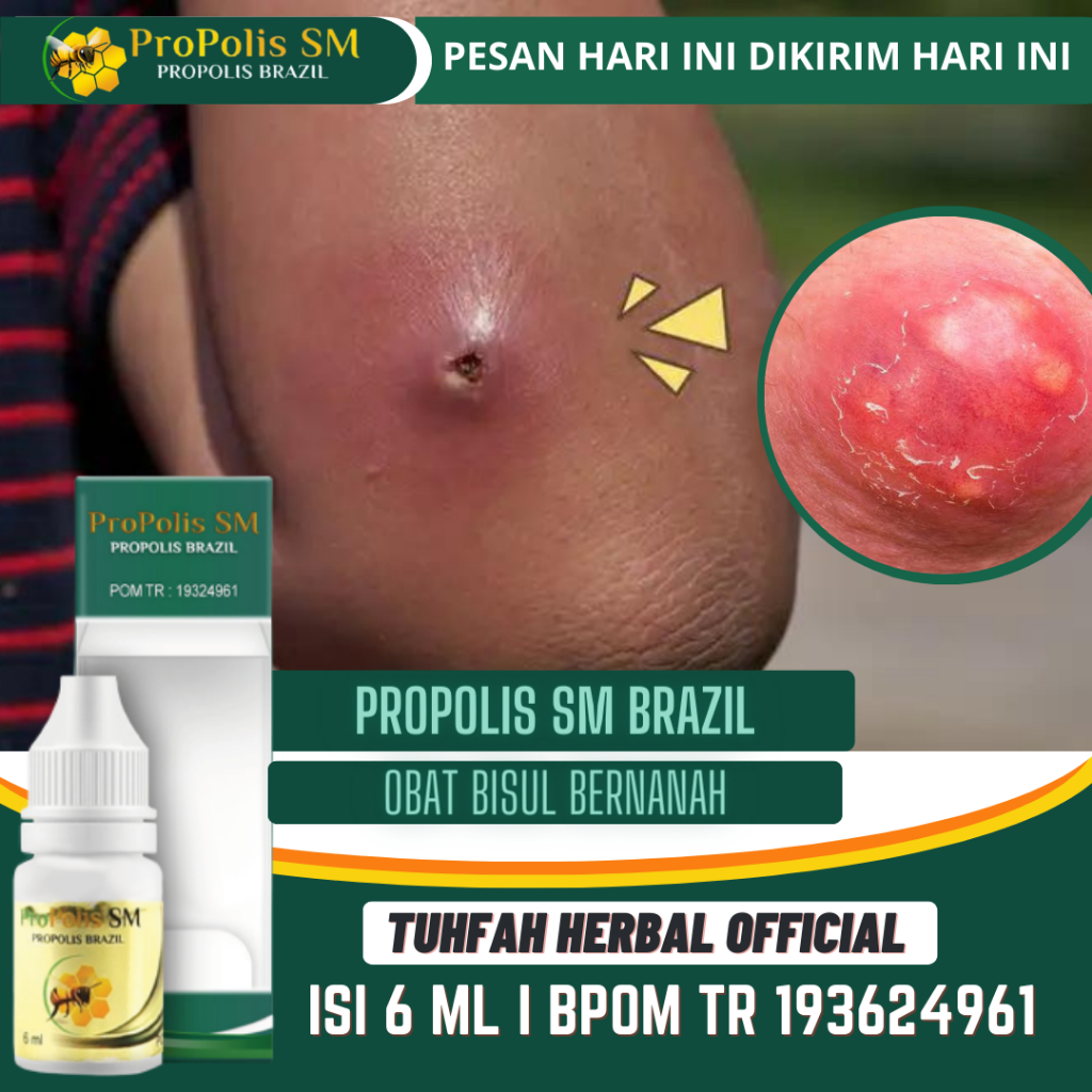 Obat Penghilang Bisul, Bisul Bayi Anak Dan Dewasa, Bisul Bernanah, Bisul di Pantat, Bisul di Tangan,