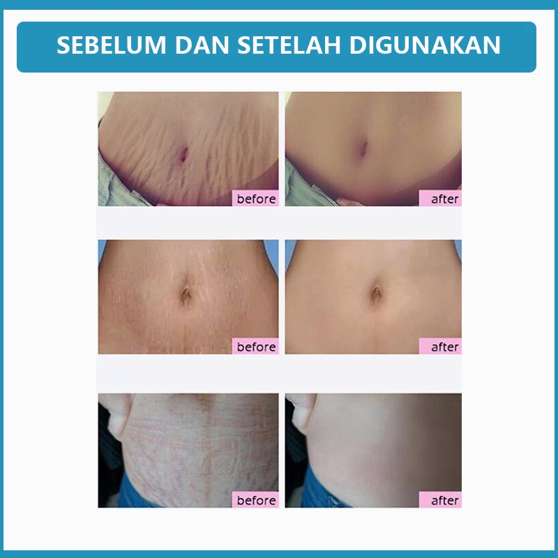 Stretch mark cream Krim stretch mark Secara efektif menghilangkan stretch mark Tujuh hari untuk menghilangkan stretch mark dengan cepat Pilihan banyak ibu