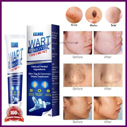 Krim Penghilang Tahi Lalat di Wajah Permanen - Sumifun Wart Remover Original