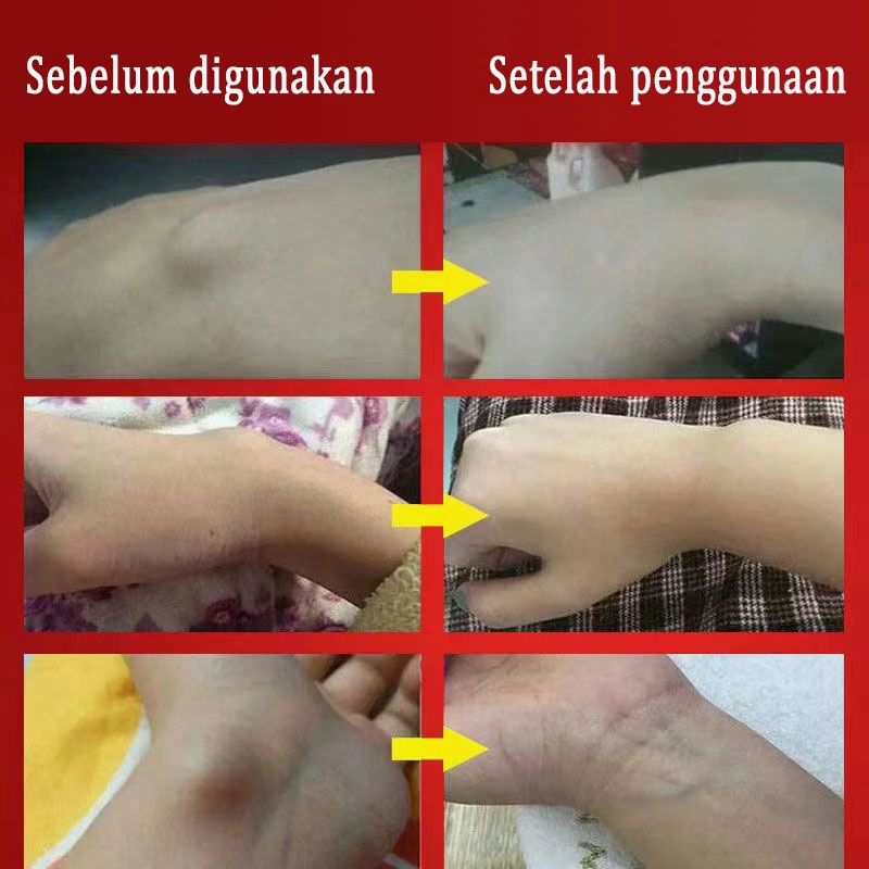 Obat Asam urat obat sendi Obat nyeri sendi pereda nyeri 30g Neuropatik yang kuat Arthropolis Otot Nyeri Angin, Nyeri Kelembapan, Asam Uric Tendonosynovitis Relief Nyeri Berkilau Cream, Tendon Tendon Tendon