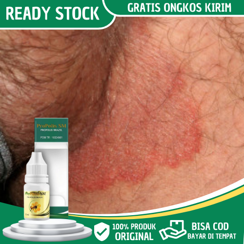 Obat Gatal Selangkangan, Salep Gatal Selangkangan, Obat Selangkangan Hitam, Obat Gatal Selangkangan 