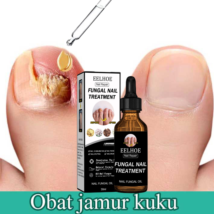 Obat Jamur Kuku Obat kuku jamur dan rusak Perawatan Kuku Berjamur Antibakteri Perawatan Kuku Onikomikosis Paronychia Anti Infeksi Kuku Toe Nail Pengobatan Jamur Minyak Nail Repair Essence Serum