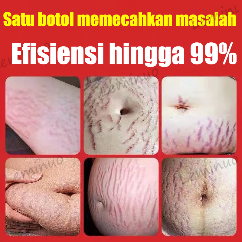 leiminuo Stretch Marks Krim Bersalin Menghilangkan Bekas Luka Kehamilan Peduli Mengencangkan Kulit Perawatan Kulit Halus-penghilang strechmark ampuh - stretch marks cream