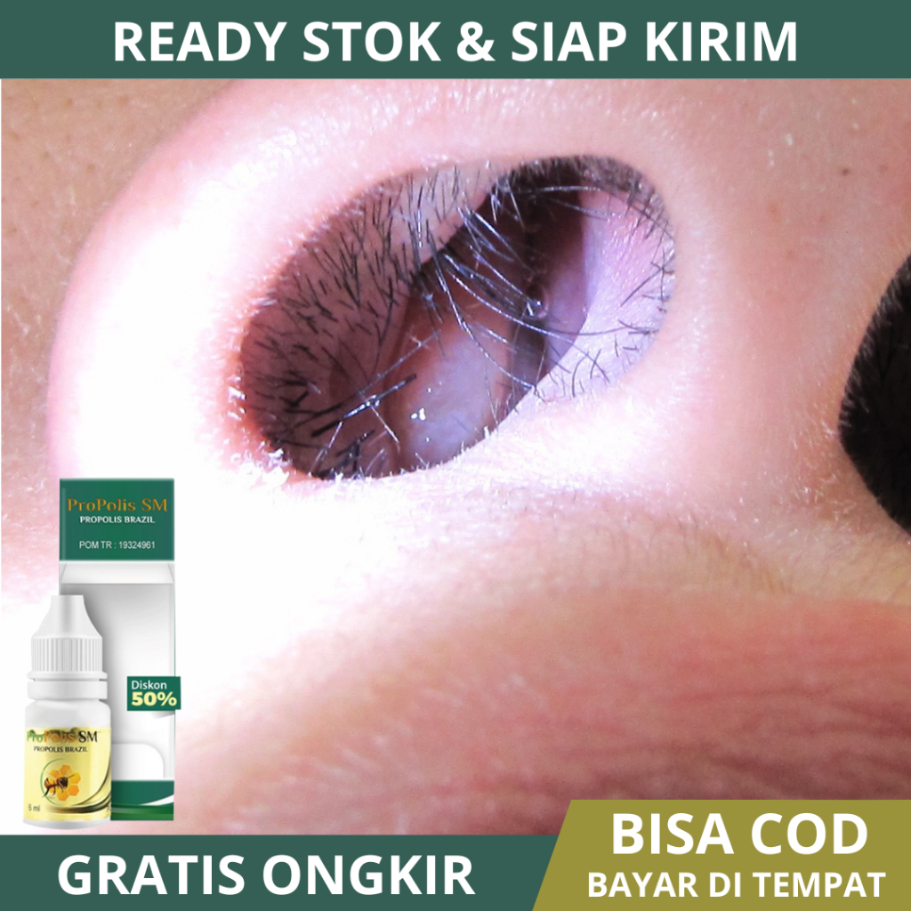 Obat Polip Hidung, Obat Polip Hidung Kronis Dan Akut, Obat Sinusitis Polip Hidung, Penghilang Polip 