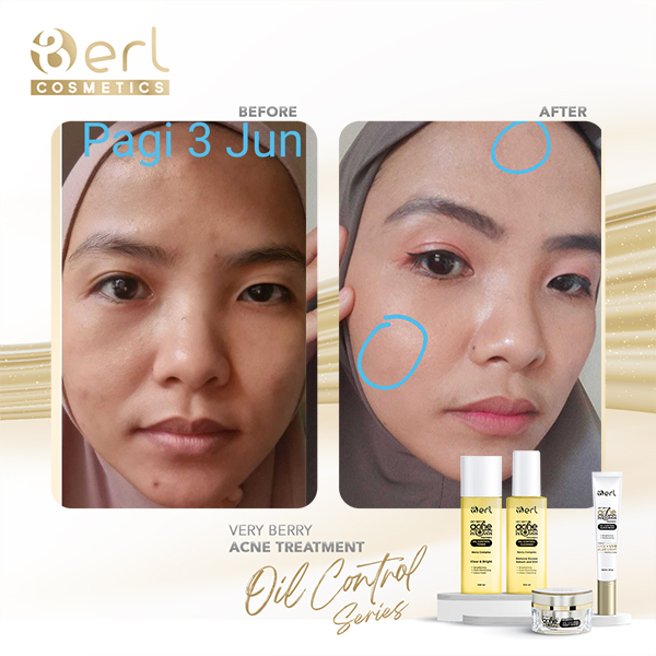 ASP POUCH B ERL COSMETICS/PAKET ASP B ERL/PAKET ACNE B ERL/B ERL PAKET JERAWAT