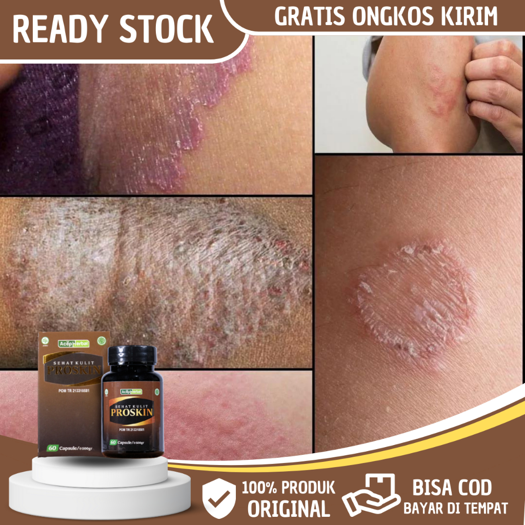 Obat Eksim Kering Menahun - Obat Exim - Obat Kurap Eksim di Selangkangan - Obat Penghilang Eksim Ker