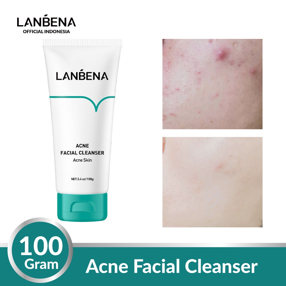 ✨ AKU MURAH ✨ LANBENA Acne Facial Cleanser / Wajah Berjerawat 100 gr