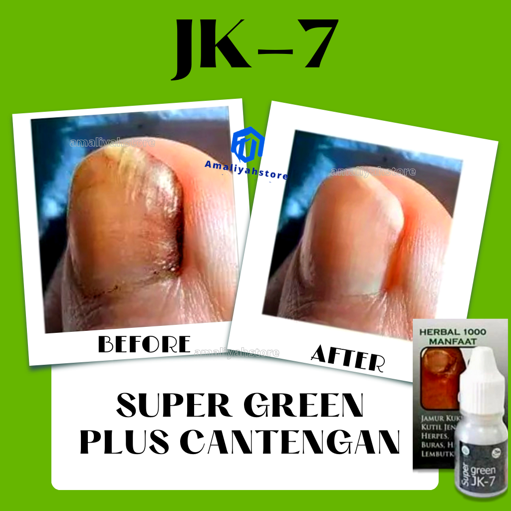 Super Green Plus Jk7 Obat Cantengan Jamur Kuku Penghalus Kulit Jempol Kaki Bersisik Kasar Pelembut Kulit Anti Kutil Mata Ikan Penghilang Ketombe Rambut 100% Original
