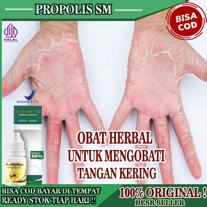 Obat Kulit Tangan Kering, Obat Jari Tangan Kering, Obat Kulit Jari Tangan Kering, Mengelupas, Pecah 