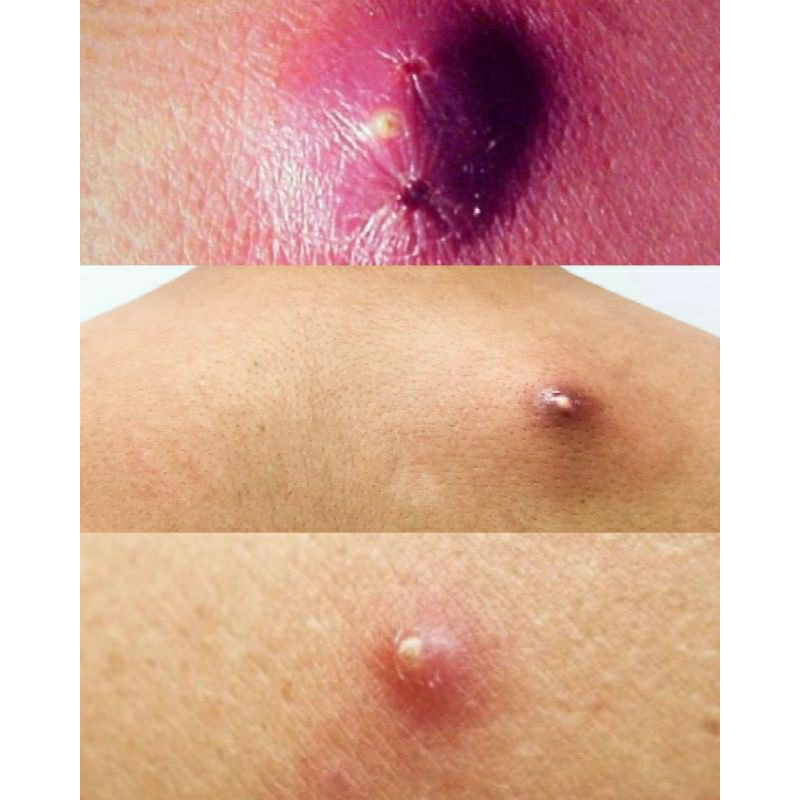 BPOM SALEP BISUL ICHTYOL