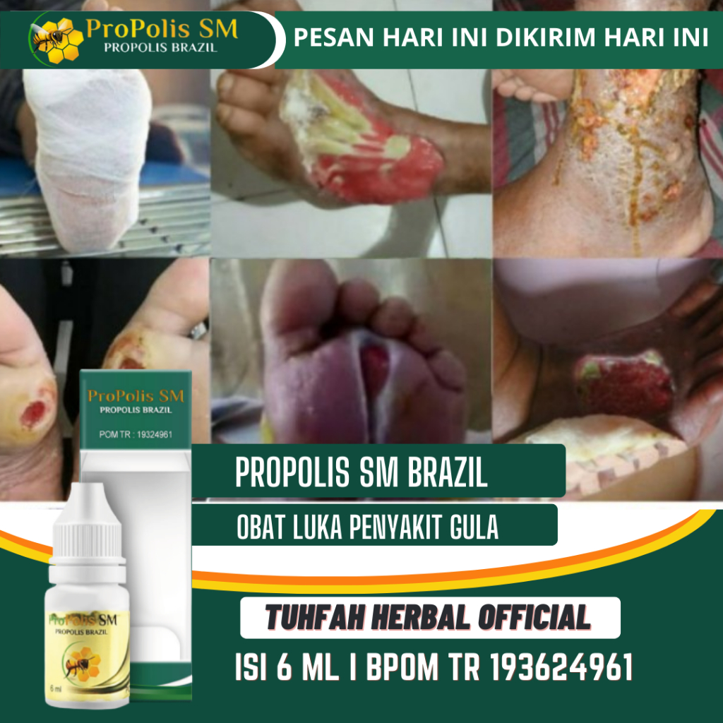 Obat Luka Bernanah Penyakit Gula, Luka Gula Menahun, Obat Luka Diabetes, Diabetes Basah Bernanah, Lu