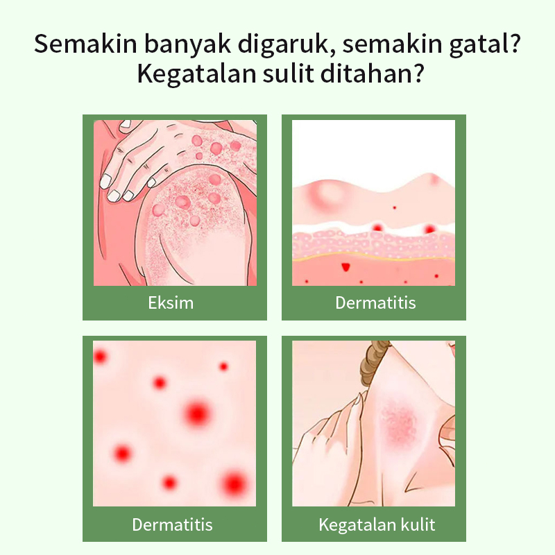 Psoriasis eksim salep gatal gatal gatal pada kulit Krim pelembap Psoriasis 30g/box perbaikan alami efektif antibakteri meringankan kulit kering gatal perawatan kulit kasar