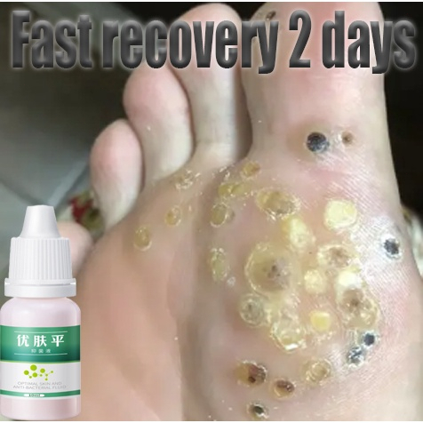 Obat kutil Obat mata ikan Cairan Anti KutilTangan Dan Kaki Menghilangkan Kutil &amp; Skin Tag Cairan Antibakteri Obat