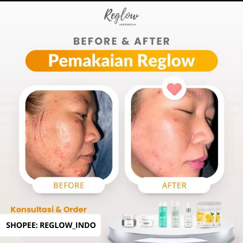 Skincare Reglow Doctor Shindy Putri 1 Paket Acne Treatment Untuk Wajah Berjerawat Kulit Berminyak Sensitif Reg glow Original Official Resmi