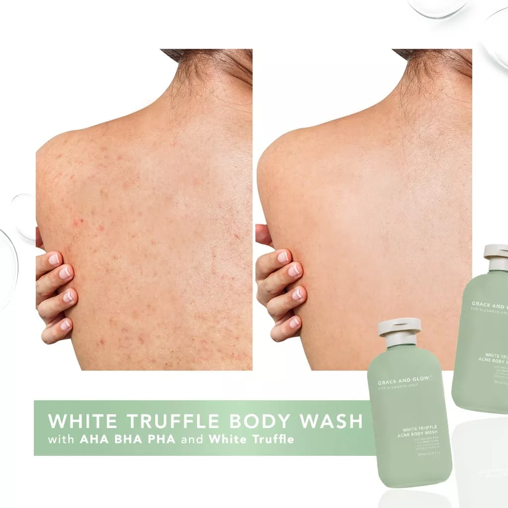 Grace and Glow White Truffle Acne Body Wash Special Edition | Shower Gel | - Sabun Mandi Cair untuk Menghilangkan Jerawat
