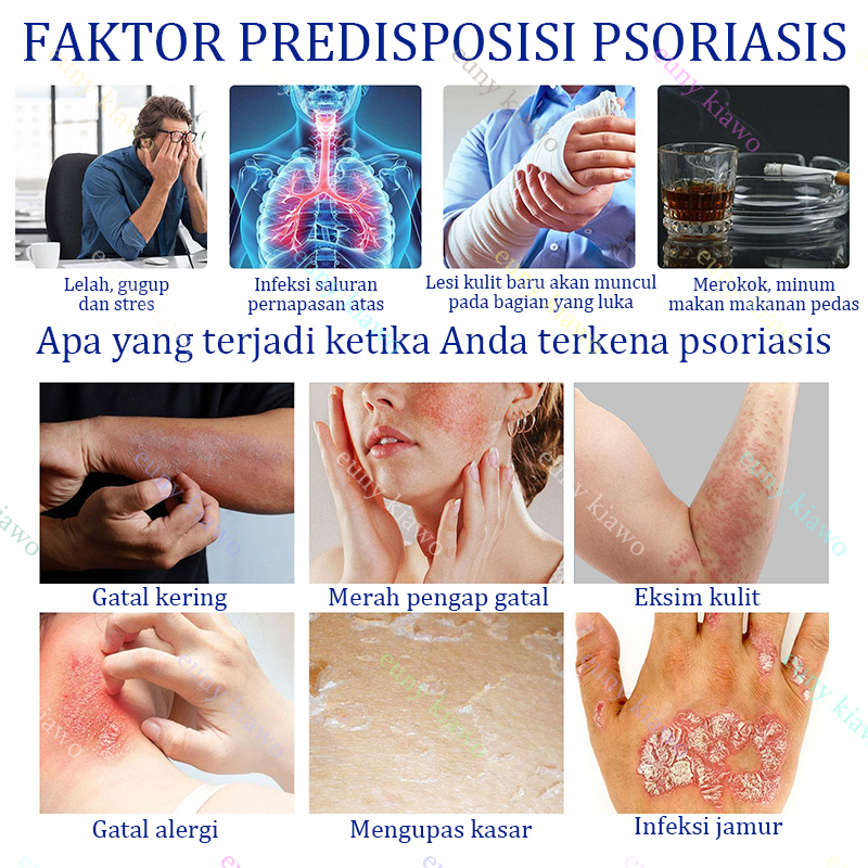 Obat Gatal Salep gatal Salep eksim Obat psoriasis Salep psoriasis 30G 【100% Original】Salep Kulit Jamur Dermatitis Psoriasis Eksim Jamur Kurap Alergi Kulit Cream Obat Gatal