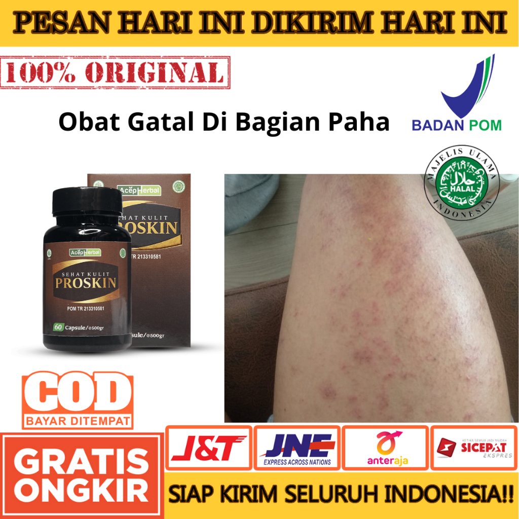 Obat Gatal- Gatal Di Bagian Paha Proskin 100% AMAN ORIGINAL