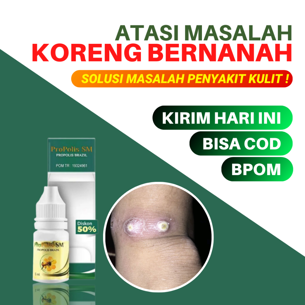 Obat Koreng Bernanah Anak Penghilang Bekas Korengan Gatal Nyeri Propolis SM 100% Original