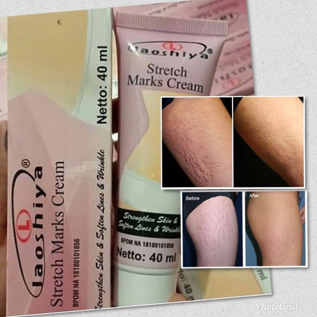 `ღ´ PHINKL `ღ´ Cream laoshiya anti strech mark bekas luka garis putih penghilang keloid