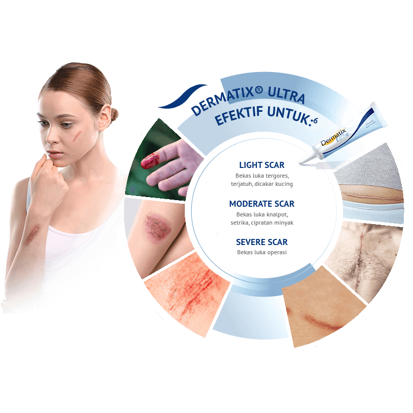 Dermatix Ultra 15gr cream penghilang keloid/stretch mark/bekas luka original