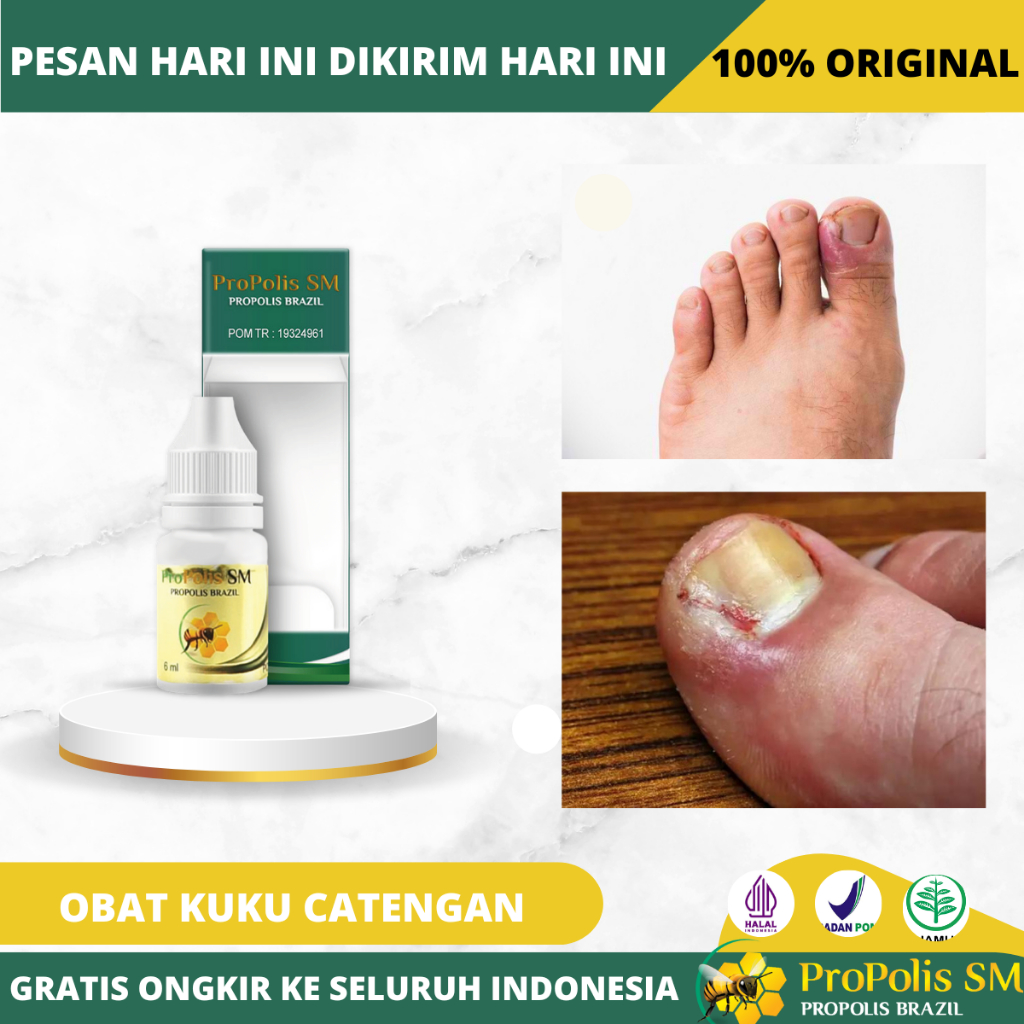 Obat Cantengan jempol kaki, Obat Tetes Cantengan, Obat Oles Kuku rusak Cantengan, Obat Cantengan Jem