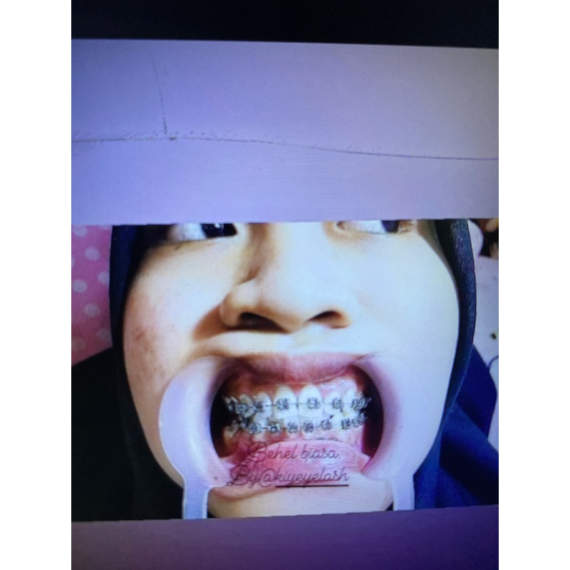 voucher pasang behel kawat gigi perawatan klinik gigi di bekasi