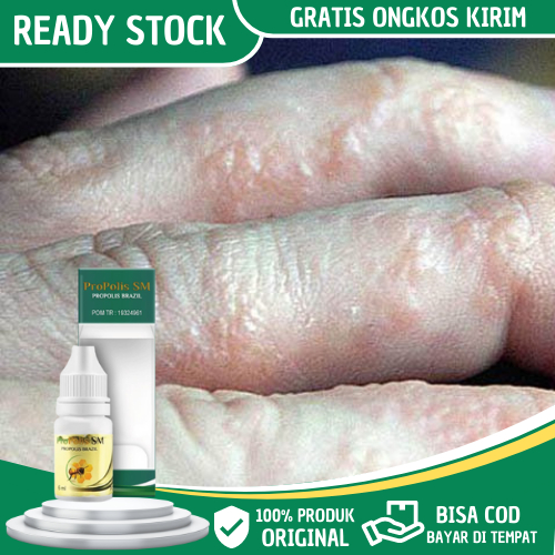 Obat Gatal Berair di Jari Tangan, Obat Gatal Berair di Jari Kaki, Obat Gatal Berair Dan Menyebar, Ob