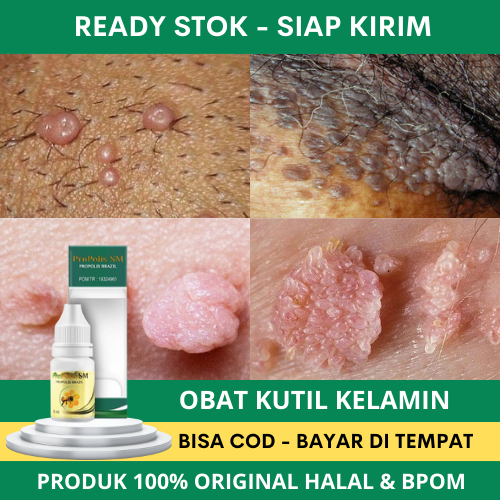 Obat Kutil Kelamin HPV, Obat Kutil Kelamin Pria, Obat Kutil Kelamin Wanita, Obat Kutil Kemaluan, Oba