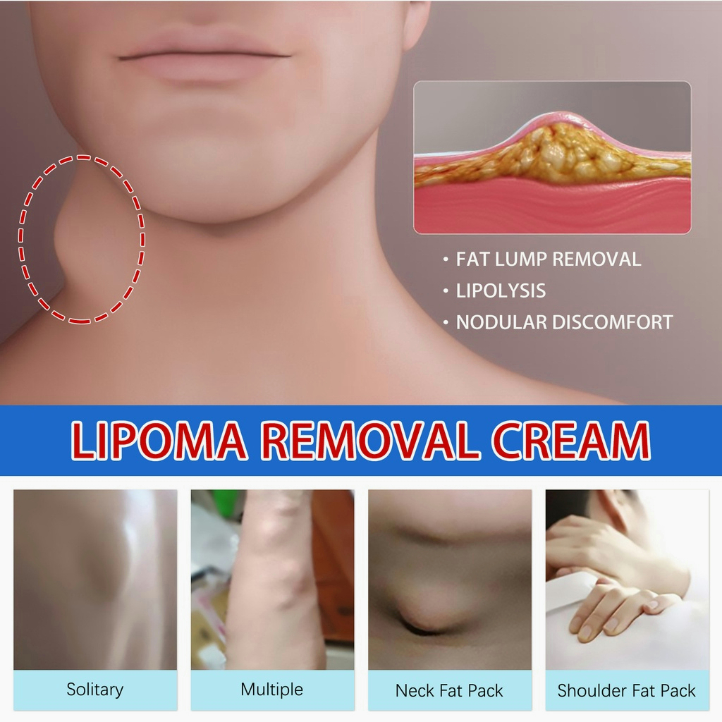 【ORIGINAL】Obat benjolan obat lipoma obat benjolan di leher 30g salep benjolan Obat Benjolan lipoma obat benjolan payudara Meredakan Benjolan Lipoma Luar Lemak Menghilangkan Tonjolan Benjolan Padat 100% asli