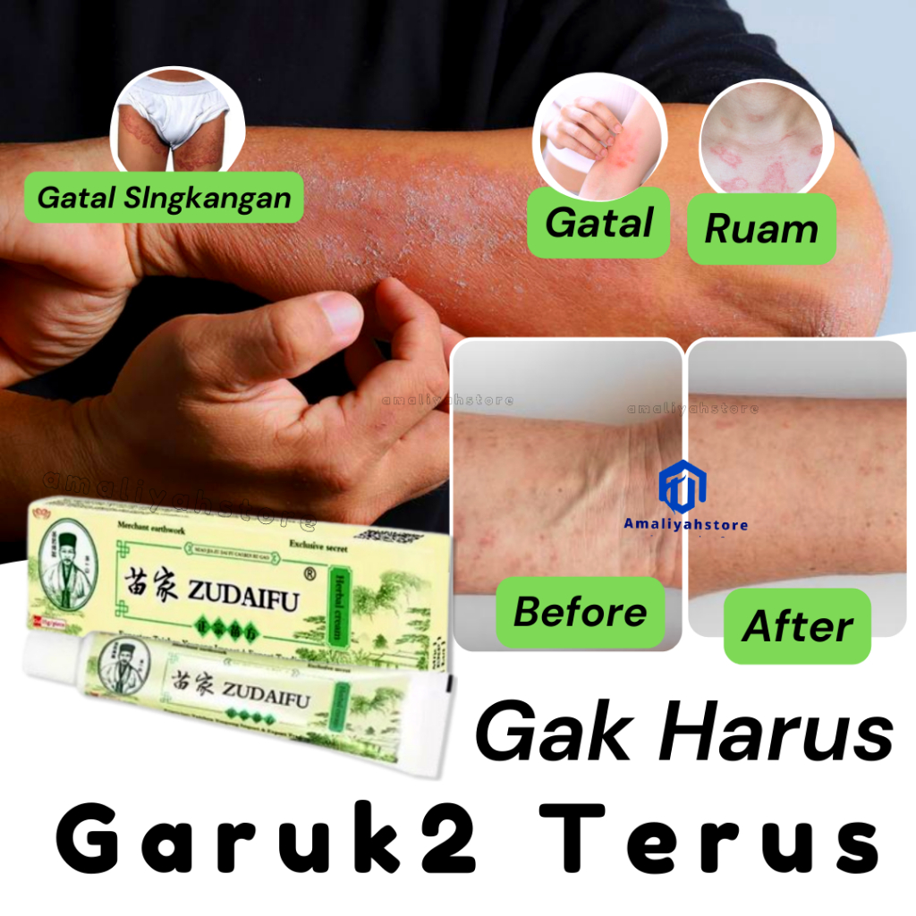 Salep Gatal Selangkangan Obat Gatal Jamur Kulit Paling Ampuh Anak Dan Dewasa Zudaifu Salep Gatal Kudis Original 15gr Original