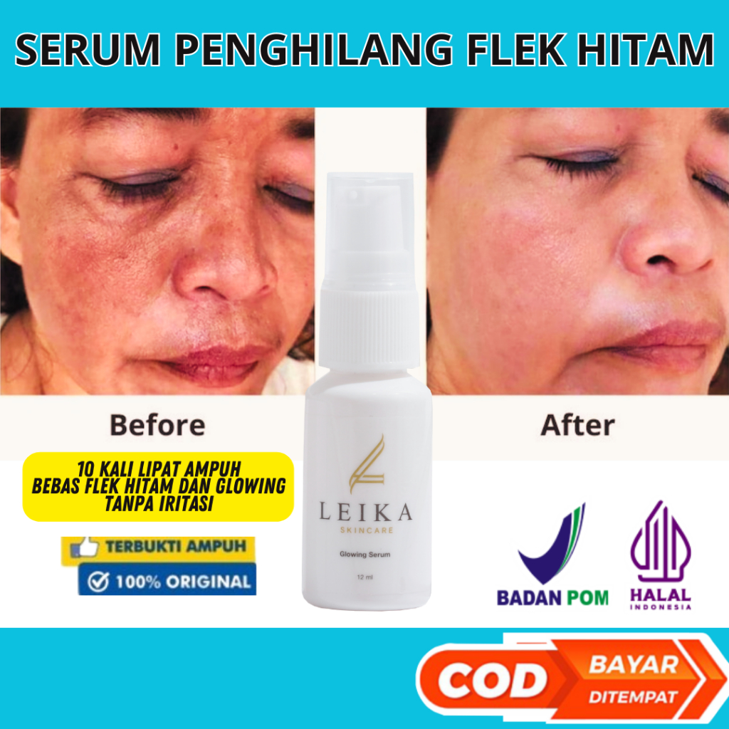 Serum flek hitam membandel paling ampuh penghilang flek hitam di wajah bpom serum melasma menghilang