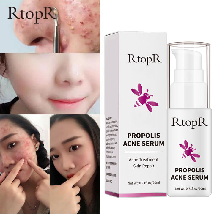 RTOPR PROPOLIS REPAIR ACNE BRIGHTENING SERUM SERUM PENCERAH KIULIT BERJERAWAT MENGHILANGKAN JERAWAT-20ml