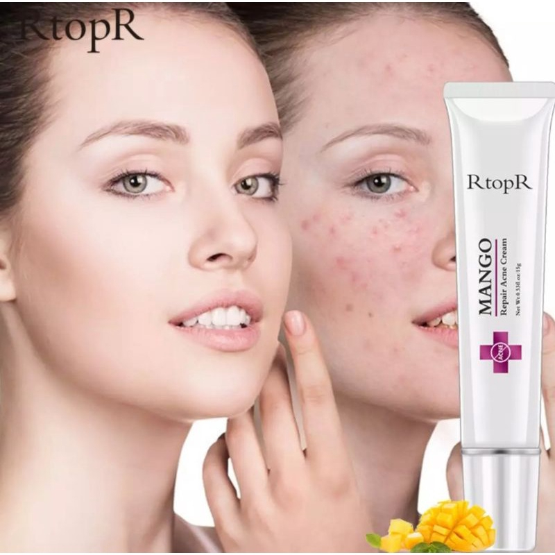 RTOPR MANGO REPAIR ACNE CREAM ANTI ACNE SPOTS ACNE TREATMENT ACNE SCAR BLACKHEAD CREAM-15gr