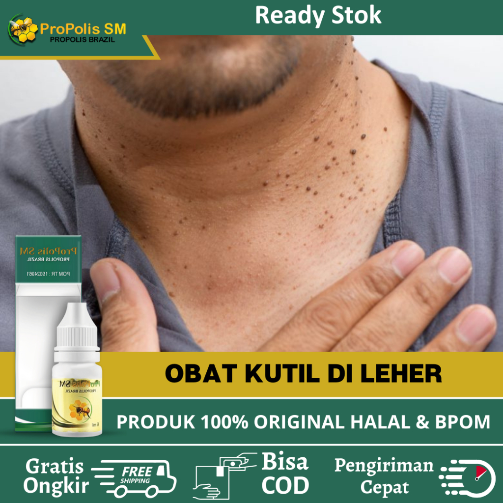 Obat Kutil Di Leher - Obat Untuk Menghilangkan Kutil Di Leher - Obat Oles Perontok Kutil Di Leher - 