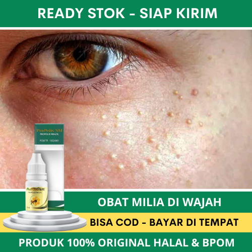 SALE Obat Herbal Penghilang Milia - Obat Milia Pada Wajah - Obat Milia Di Wajah - Obat Milia Diarea 