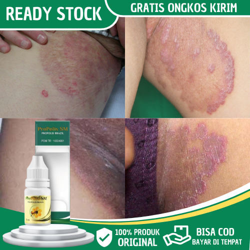 obat gatal selangkangan, obat gatal di selangkangan, obat penghilang gatal selangkangan, obat gatal 